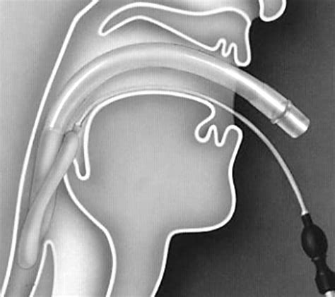 Laryngeal Mask Airway Insertion