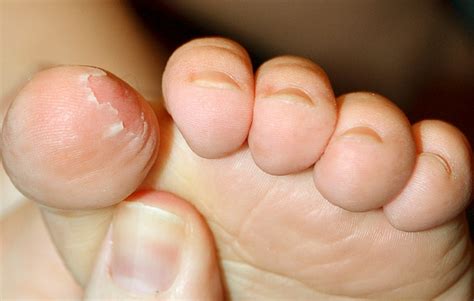 Skin Peeling On Feet Symptoms Causes Treatment Remedies