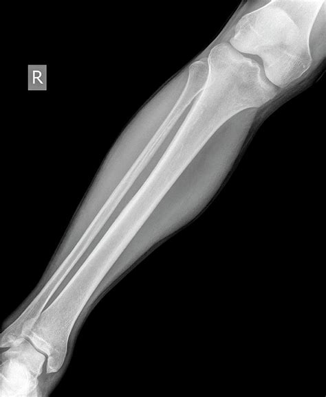 X Ray Leg Bones