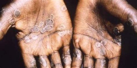 Uk Confirms More Cases Of Monkeypox Fox News