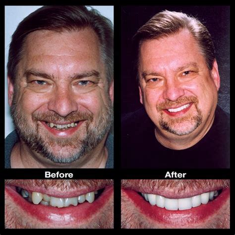 Crooked Teeth Treatment Oppenheim Signature Smiles