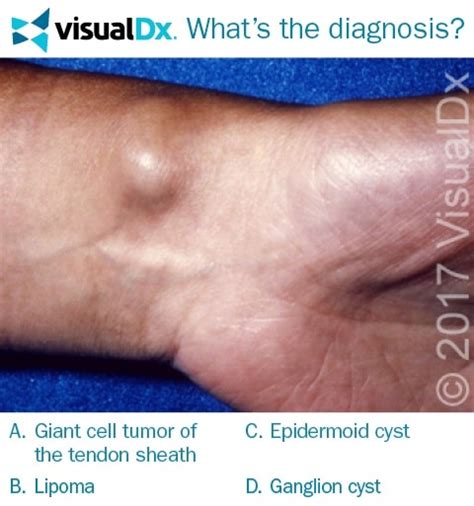Lump Develops On Patients Wrist Can You Diagnose Visualdx