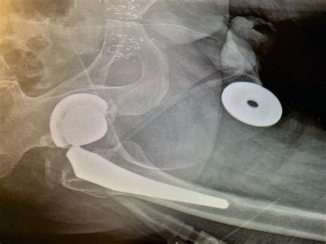Case Study Revision Hip Replacement For Fractured Implant