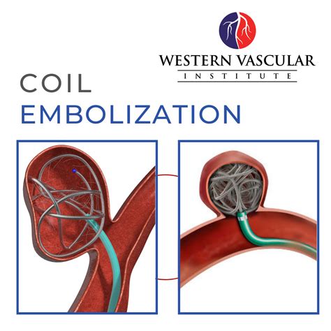 Coil Embolization Aneurysm Vascular Aortic Aneurysm