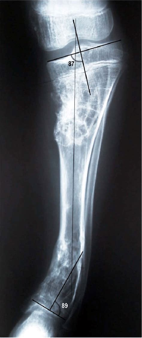 Ap Radiograph Of A Tibia With Proximal And Distal Metaphyseal