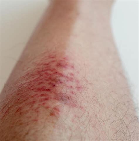 How Do I Treat A Rash From Antibiotics With Pictures