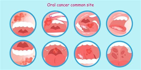 Everything To Know About Oral Cancer Causes Risks And Prevention — Medipulse Best Private