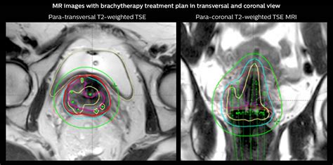 mri guided brachytherapy cervix fieldstrength philips