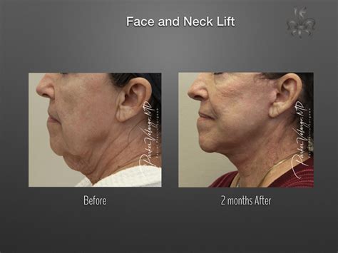 Facelift New Orleans Neck Lift Facial Rejuvenation With Dr Velargo