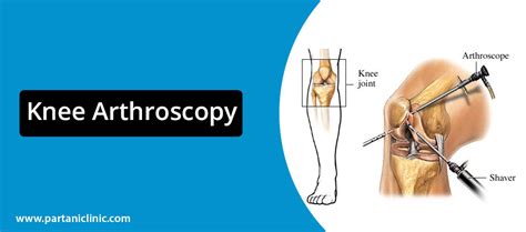 Knee Arthroscopy In Jaipur Arthoscopic Surgeon Dr Arun Partani