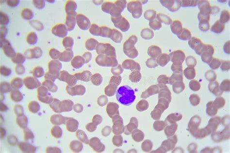 Leukemia Cells Stock Photo Image Of Cancer Microscopic 92253812