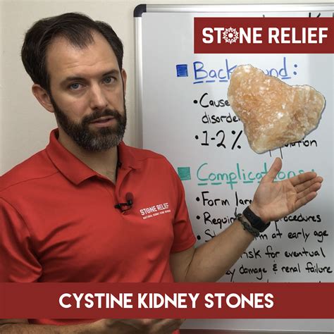 Cystine Kidney Stones