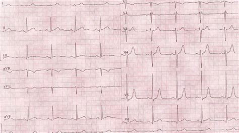 A 50 Year Old Female Asymptomatic Athlete With Mitral Valve Prolapse
