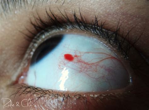 Causes Of A Red Spot On Eye Youmemindbody Health And Wellness