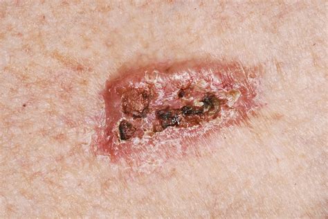 Basal Cell Carcinoma Stock Image C0401408 Science Photo Library