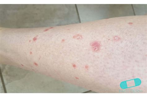 Itchy Red Bumps On Skin Potential Causes And Treatment