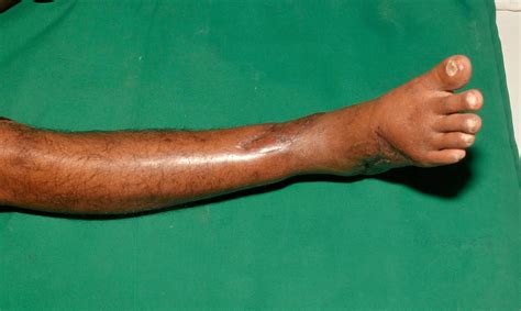 Open Ankle Joint Fracture Dislocation Debridement Free Gracilis