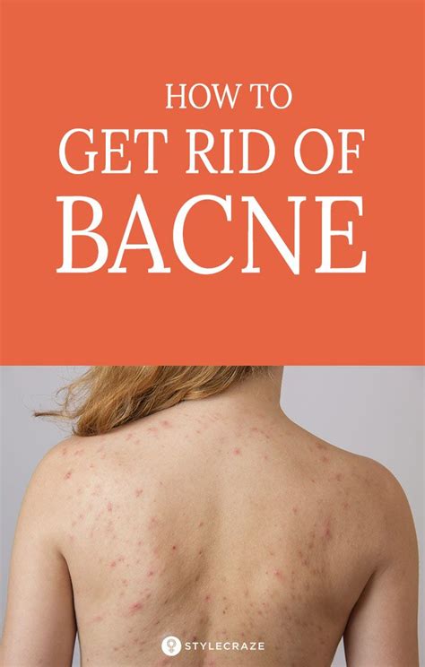 How To Get Rid Of Bacne For Good Bacne Get Rid Of Bacne Natural