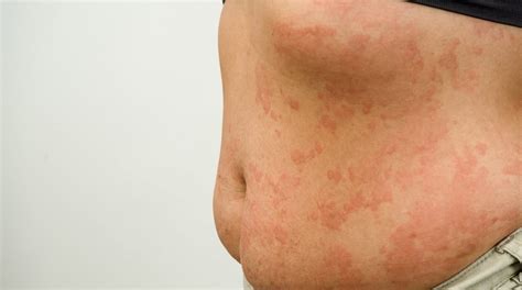 A Quick Overview Of Cold Urticaria Symptoms And Treatment