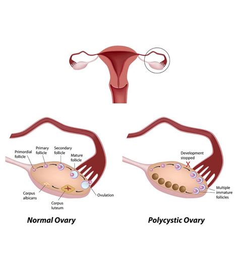 Can Ovarian Cysts Prevent Pregnancy