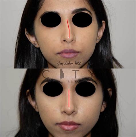 Face Expert Dr. Linkov Goes In Depth On His Approach To A ...