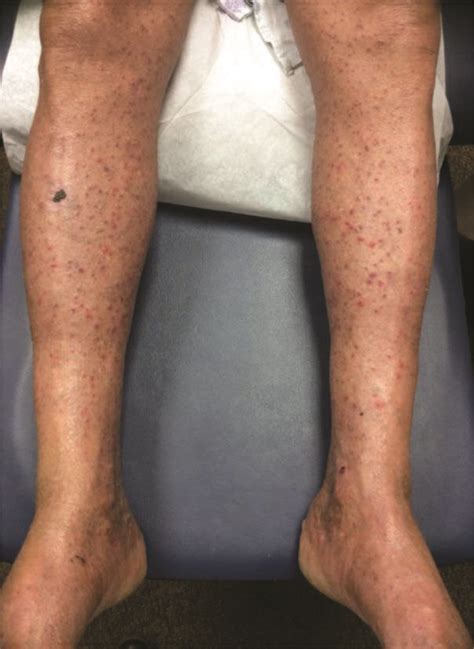 Bledea A Report Of Polymorphous Toxic Erythema Of Chemotherapy During