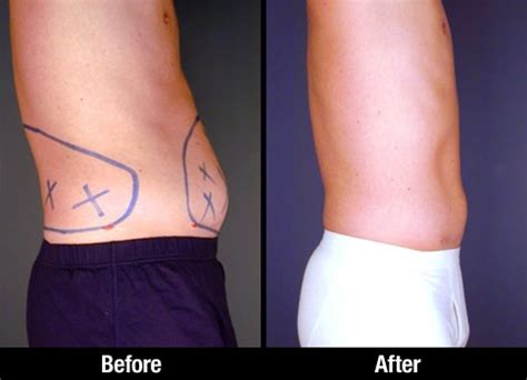 Male Liposuction Patient Before After Picture Of Tumescent