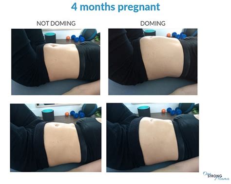 It is estimated about 60% of women suffer from some level of diastasis recti immediately postpartum. Diastasis Recti During Pregnancy - RYC