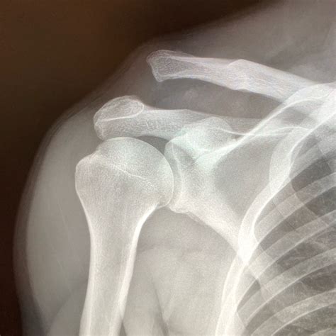 Acromioclavicular Ac Joint Separations Andrew Dold Md Orthopedic Surgeon And Sports