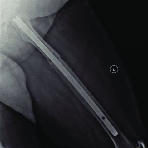 Radiograph Of The First Fracture Of The Patient On The Left Femur Taken