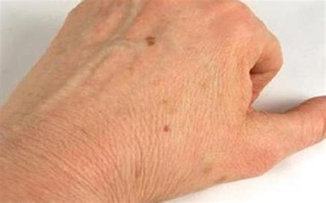Indications Of Brown Spots On The Skin