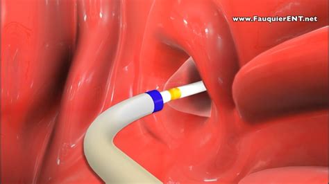 Balloon Eustachian Tube Dilation To Treat Eustachian Tube Dysfunction