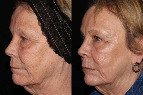 ProFractional Laser Resurfacing Before And After Pictures Case Chico Yuba City