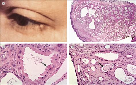 Moll Gland Neoplasms Of The Eyelid A Clinical And