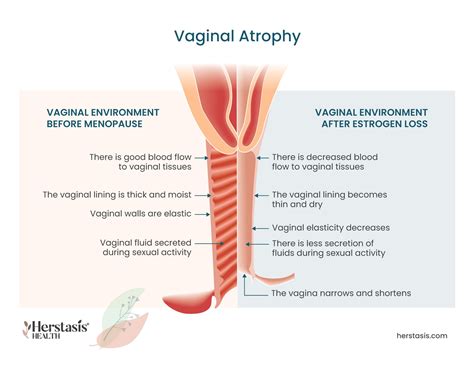 Vaginal Changes Therapies For Vaginal Dryness And Urine Leakage Blood Flow To The Vagina