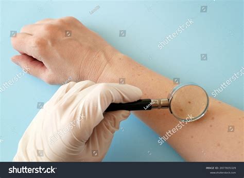Doctor Dermatologist Examines Birthmark Patient Checking Stock Photo