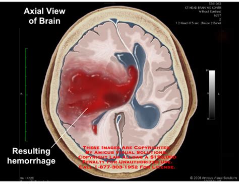 Hemorrhage Resulting From Brain Infarct