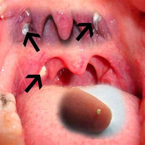 Laser Removal Tonsil Stones Cancer Tonsils Throat Cedag Media Tonsil