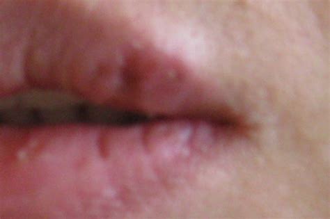Ways To Prevent And Treat Of Cold Sores Hubpages