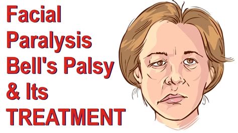 Bells Palsy Cause Symptom Physiotherapy Treatment Exercise