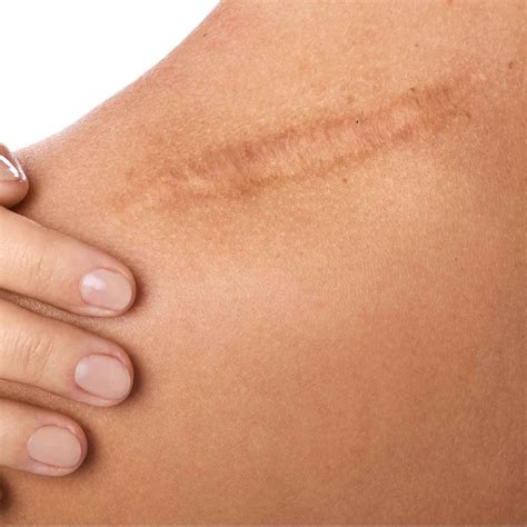 Keloid And Hypertrophic Scars