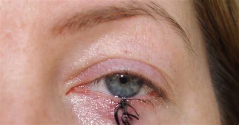 Design 45 Of Bed Bug Bite On Eyelid Pictures Waridhellotones