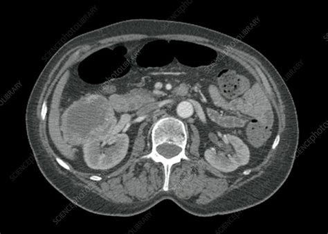 Kidney Cancer Ct Scan Stock Image C0267597 Science Photo Library