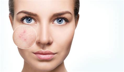 Experiencing Mild To Moderate Acne Here Are 4 Treatment Options You