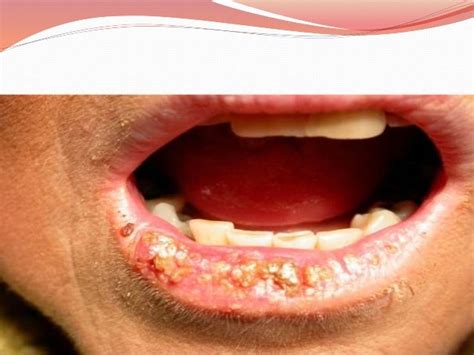 Lip Diseases Images