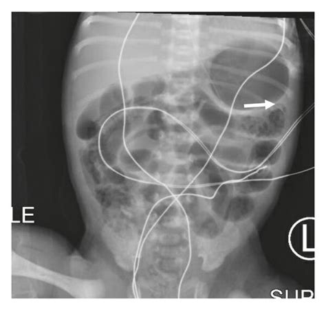 Abdominal X Rays Of The Premature Infant A Image Obtained At 30 H Of