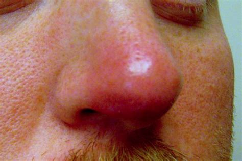 Painful Sores In Nose Causes Treatment Pictures Public Health My Xxx