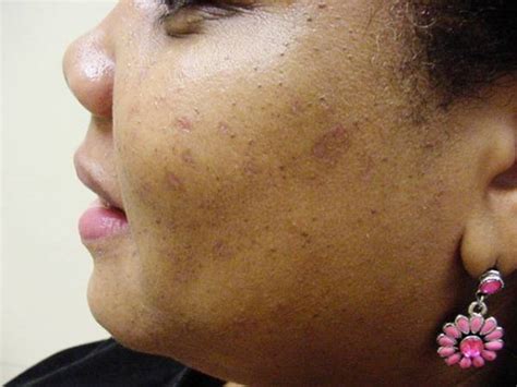 Marietta Ga Mole Scar Removal Before And After Photos Kennesaw East