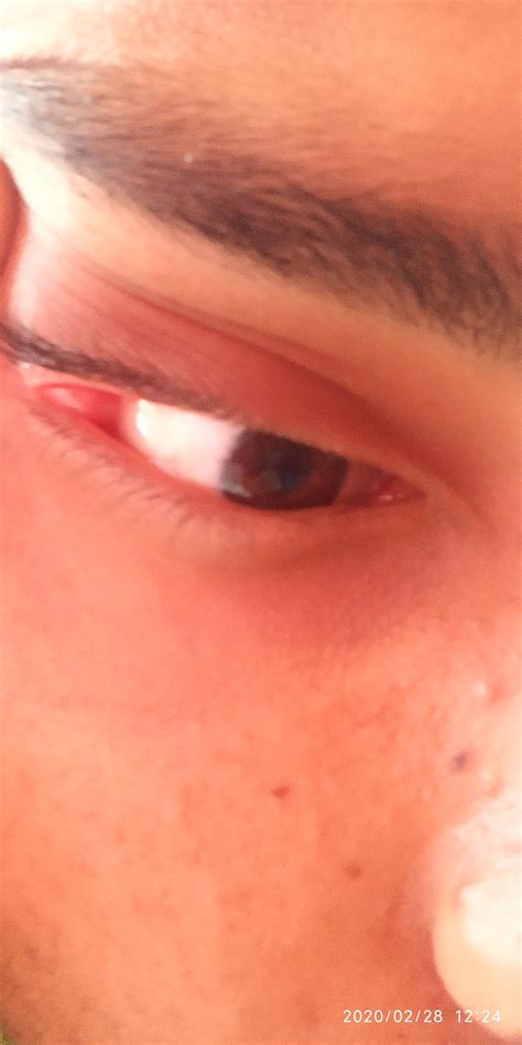 The Rightmost Corner Of My Right Eye Is Swollen And Causing Pain