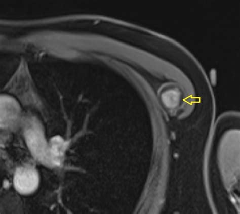 Cureus Chest Wall Schwannoma Case Report And A Review Of Imaging